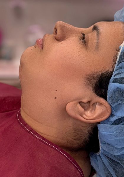 Chin Liposuction Before & After Patient #4259