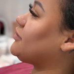 Chin Liposuction Before & After Patient #4265