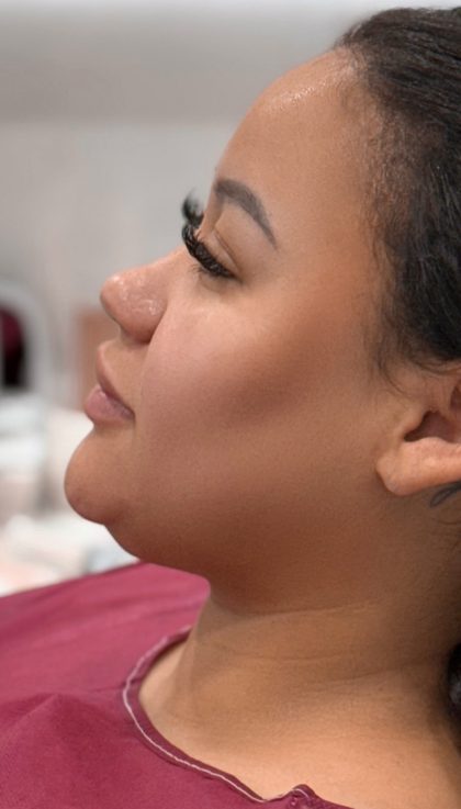 Chin Liposuction Before & After Patient #4265
