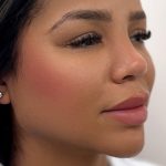 Facial Balancing With Fillers Before & After Patient #4274