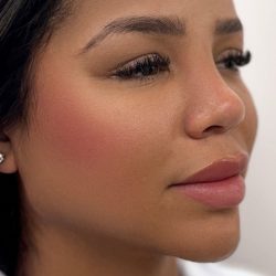 Facial Balancing With Fillers Before & After Patient #4274
