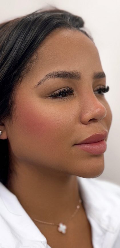 Facial Balancing With Fillers Before & After Patient #4274