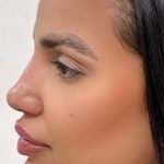 Facial Balancing With Fillers Before & After Patient #4280