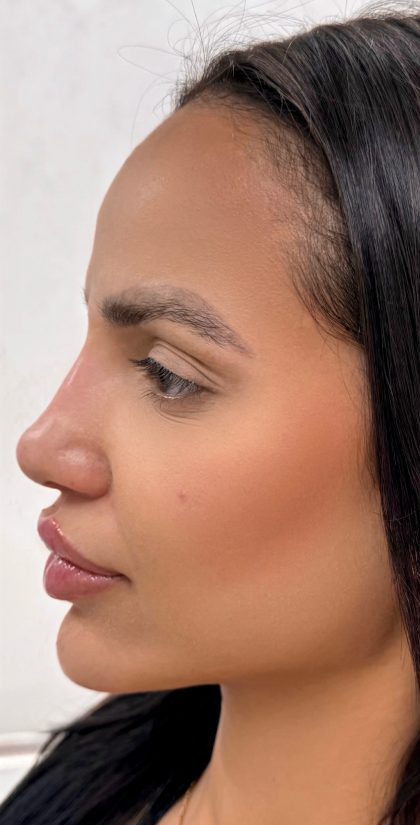 Facial Balancing With Fillers Before & After Patient #4280