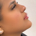 Facial Balancing With Fillers Before & After Patient #4283