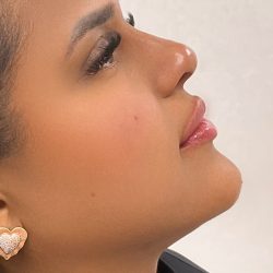 Facial Balancing With Fillers Before & After Patient #4283