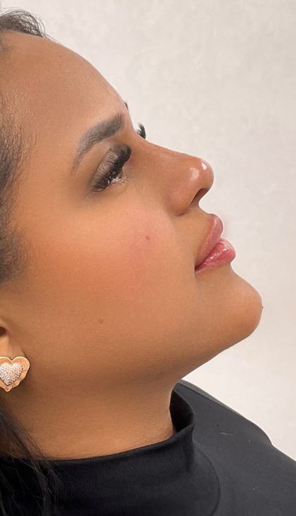 Facial Balancing With Fillers Before & After Patient #4283