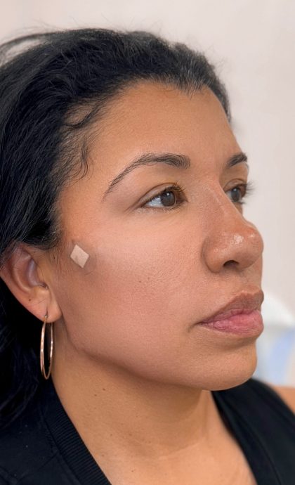 Fillers + Thread Lift Before & After Patient #4292