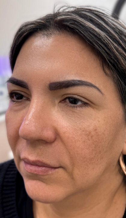 Fillers + Thread Lift Before & After Patient #4295