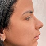 Fillers + Thread Lift Before & After Patient #4298