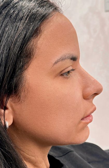 Fillers + Thread Lift Before & After Patient #4298