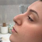 Liquid Rhinoplasty Before & After Patient #4319