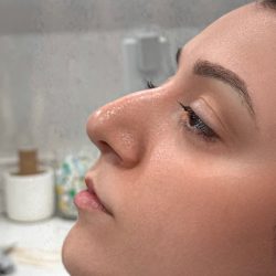 Liquid Rhinoplasty Before & After Patient #4319