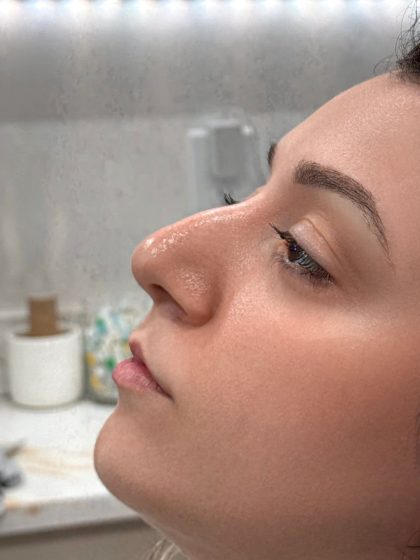 Liquid Rhinoplasty Before & After Patient #4319