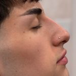 Liquid Rhinoplasty Before & After Patient #4322