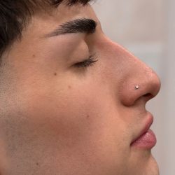 Liquid Rhinoplasty Before & After Patient #4322