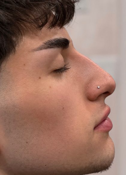 Liquid Rhinoplasty Before & After Patient #4322