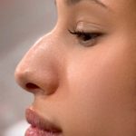 Liquid Rhinoplasty Before & After Patient #4325
