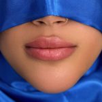 Russian Lips Before & After Patient #4331