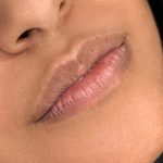 Russian Lips Before & After Patient #4334