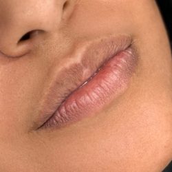 Russian Lips Before & After Patient #4334