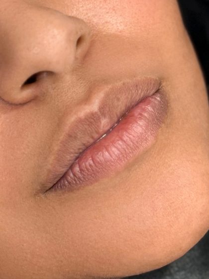 Russian Lips Before & After Patient #4334