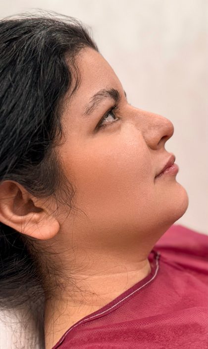 Chin Liposuction Before & After Patient #4237