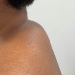 Buffalo Hump Removal Before & After Patient #4350