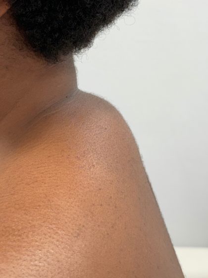 Buffalo Hump Removal Before & After Patient #4350