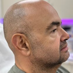 Fillers + Thread Lift Before & After Patient #4365