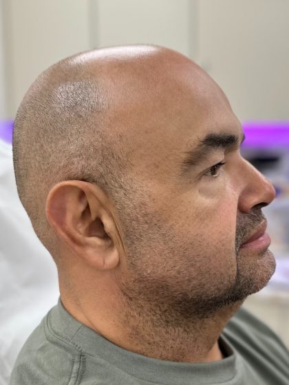 Fillers + Thread Lift Before & After Patient #4365