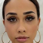 Fox Eye Threadlift Before & After Patient #4370