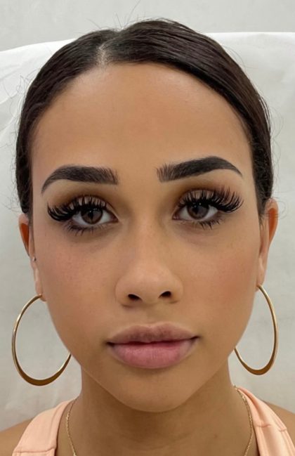 Fox Eye Threadlift Before & After Patient #4370