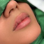 Russian Lips Before & After Patient #4388