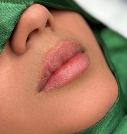 Russian Lips Before & After Patient #4388