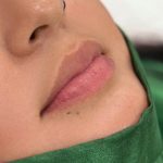 Russian Lips Before & After Patient #4394