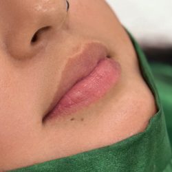 Russian Lips Before & After Patient #4394