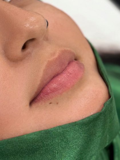 Russian Lips Before & After Patient #4394