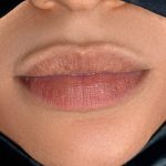 Russian Lips Before & After Patient #4397