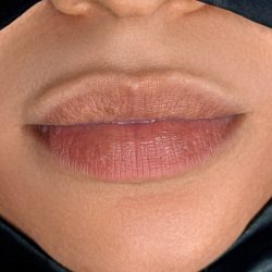 Russian Lips Before & After Patient #4397