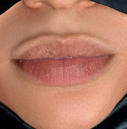 Russian Lips Before & After Patient #4397