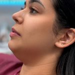 Chin Liposuction Before & After Patient #4243