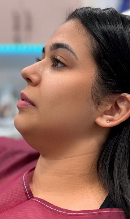 Chin Liposuction Before & After Patient #4243