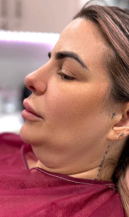 Chin Liposuction Before & After Patient #4246