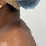 Buffalo Hump Removal Before & After Patient #4350