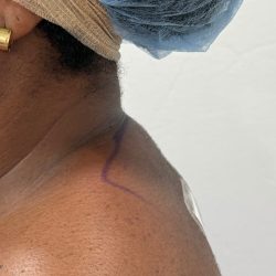 Buffalo Hump Removal Before & After Patient #4350