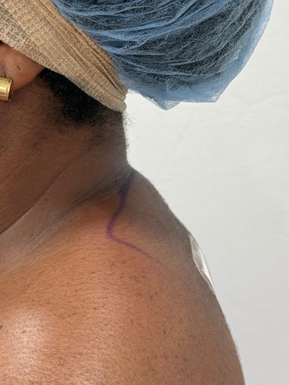 Buffalo Hump Removal Before & After Patient #4350