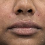 Smile Lines Treatment Before & After Patient #4385