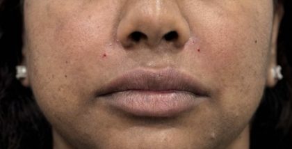 Smile Lines Treatment Before & After Patient #4385
