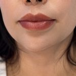 Chin Filler Before & After Patient #4225